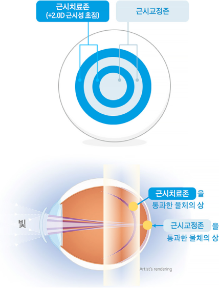 시력교정의 원리